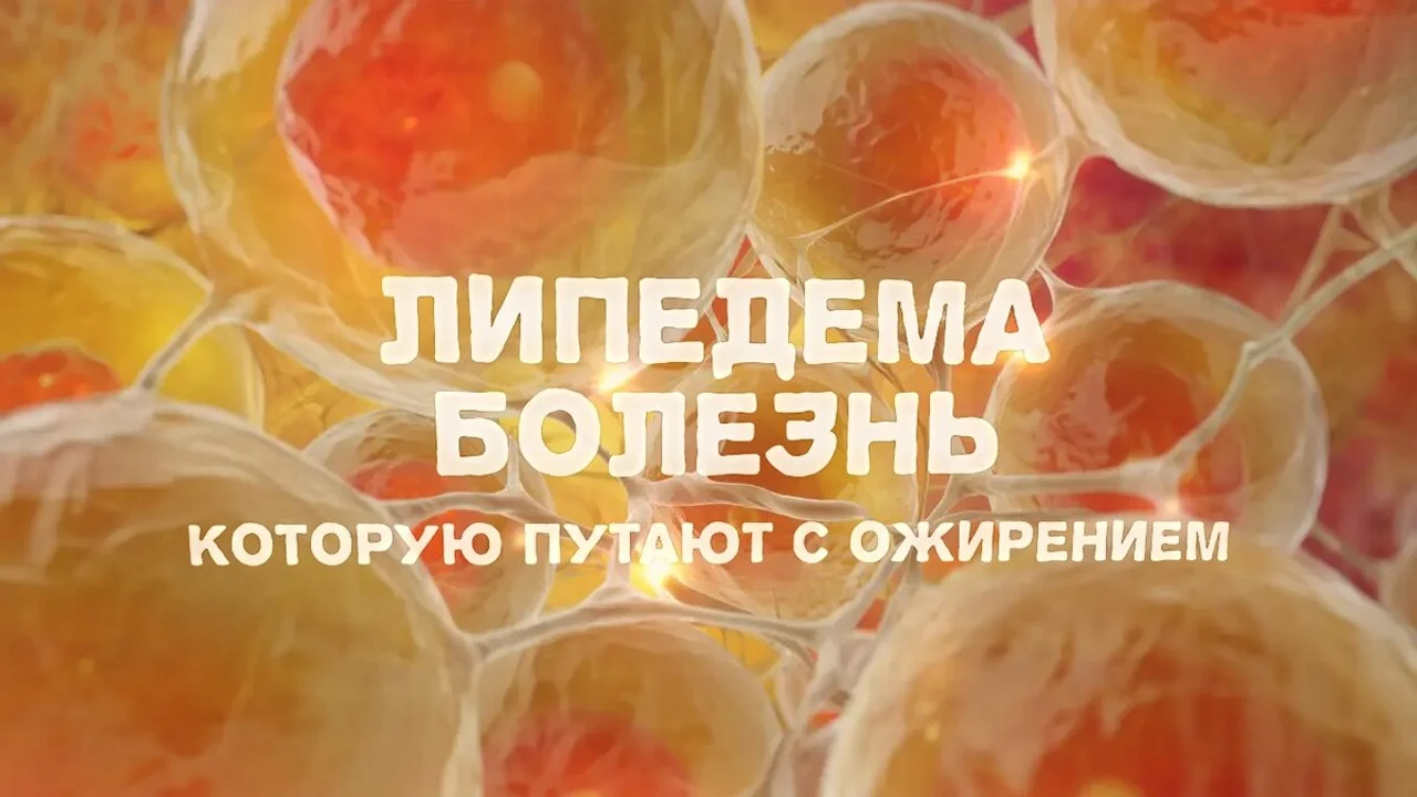 Липедема — болезнь, которую путают с ожирением