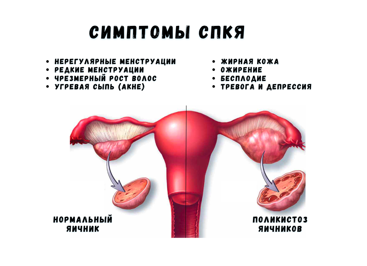 СПКЯ и инсулинорезистентность