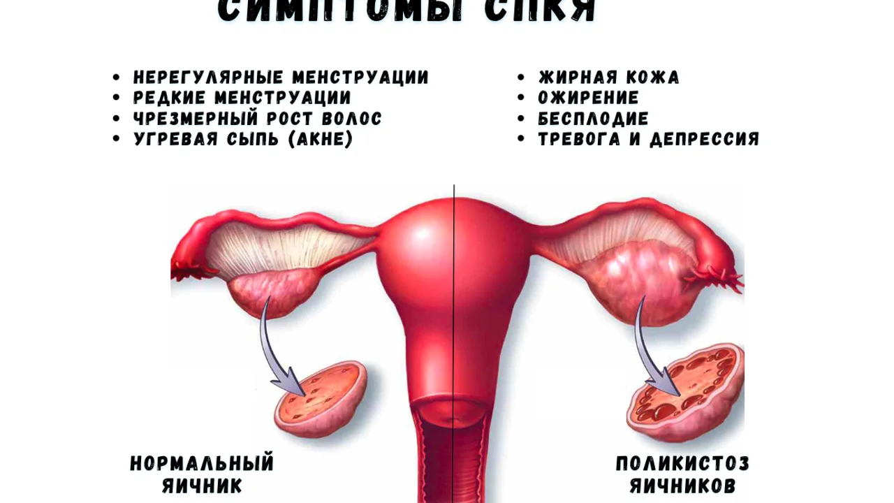 СПКЯ и инсулинорезистентность